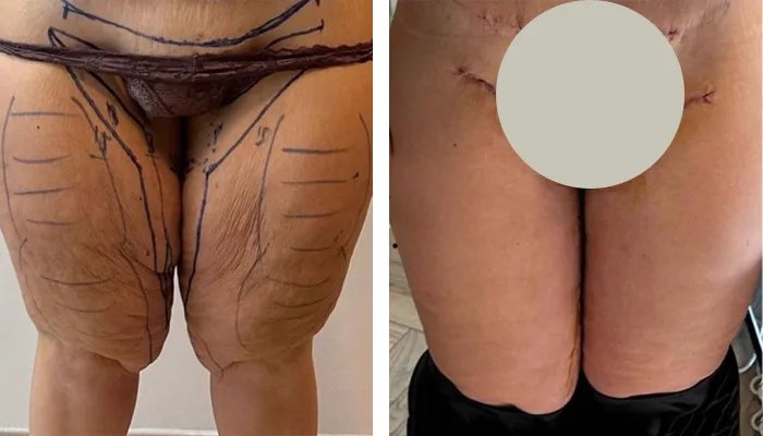 before & after photo of Thigh Lift