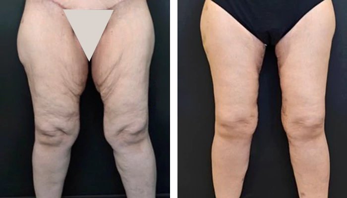 before & after photo of Thigh Lift