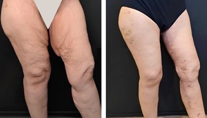 before & after photo of Thigh Lift