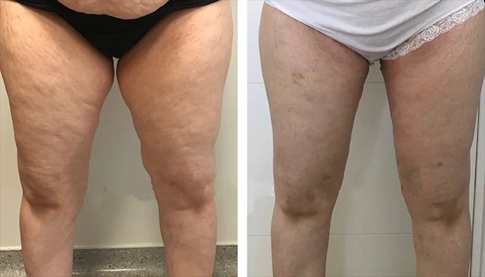 before & after photo of Thigh Lift