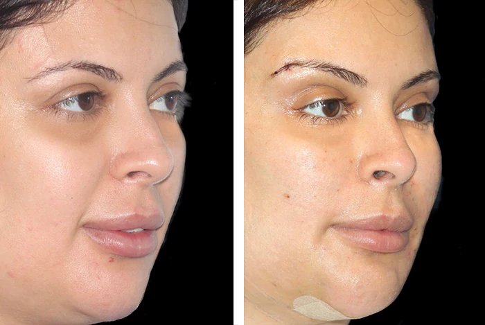before & after photo of thread-lift
