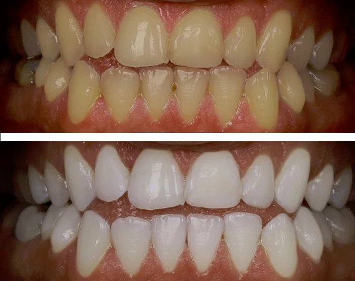 before & after photo of Teeth Whitening