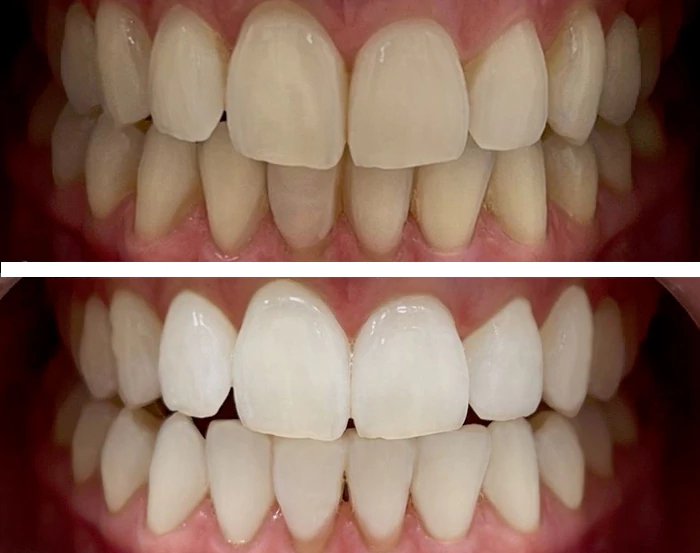 before & after photo of Teeth Whitening