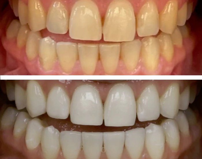 before & after photo of Teeth Whitening