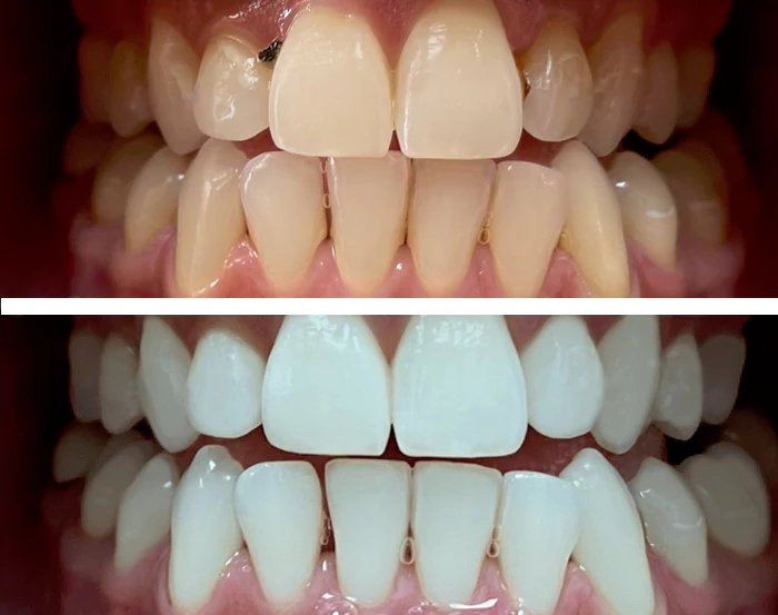 before & after photo of teeth-whitening