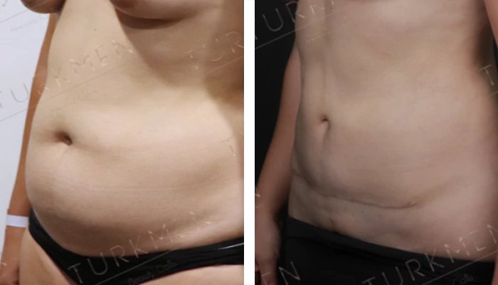 before & after photo of Tummy Tuck