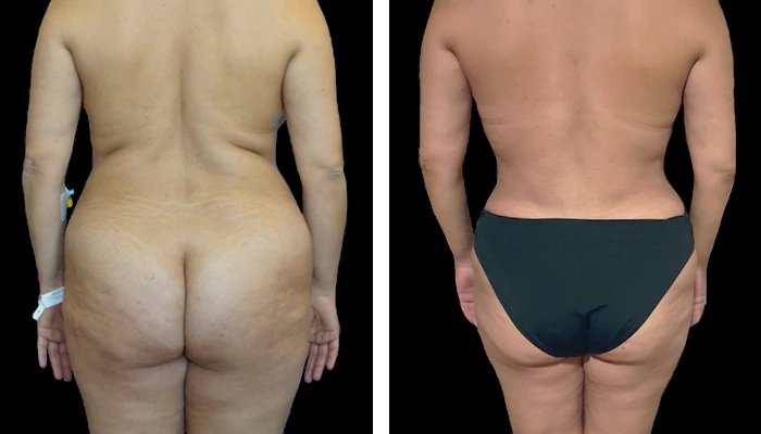 before & after photo of Tummy Tuck