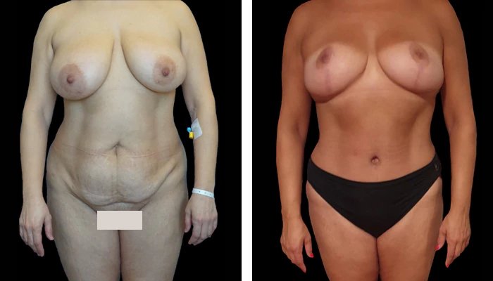 before & after photo of Tummy Tuck