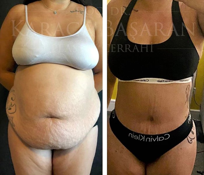 before & after photo of Tummy Tuck