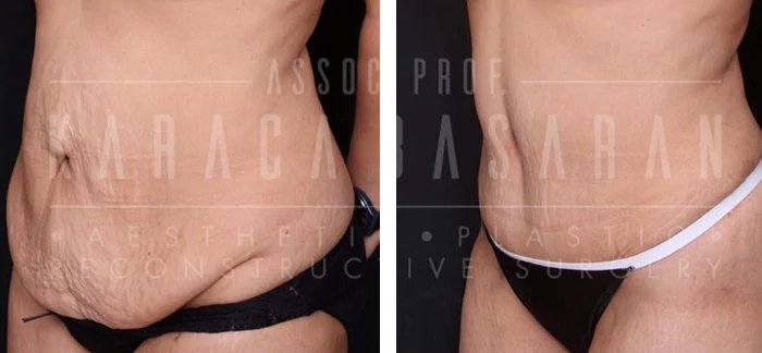 before & after photo of Tummy Tuck