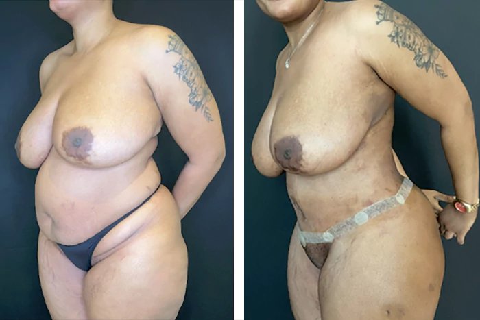 before & after photo of Tummy Tuck