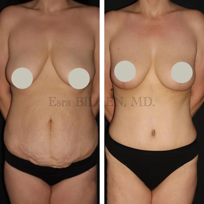 before & after photo of Breast Lift