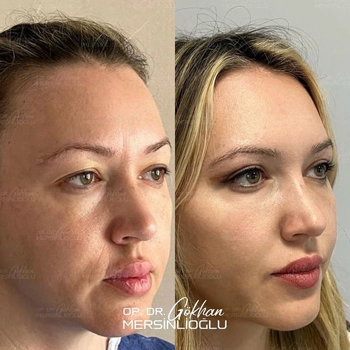 before & after photo of عملية تجميل الجفون