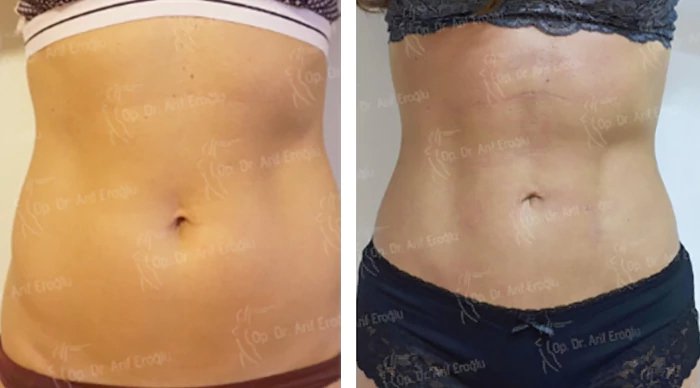 before & after photo of Liposuction