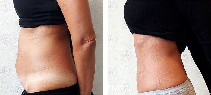 before & after photo of Tummy Tuck