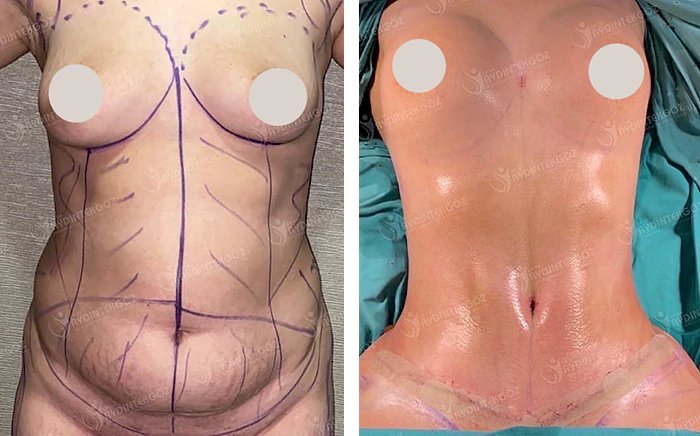 before & after photo of Abdominal Etching