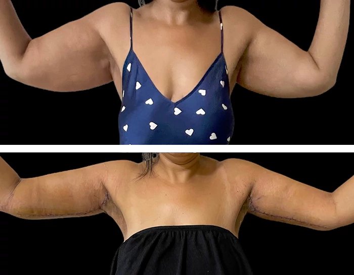 before & after photo of Arm Lift