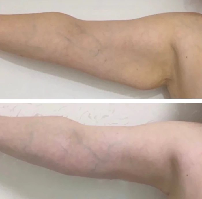 before & after photo of Arm Lift