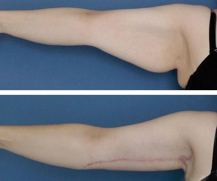 before & after photo of Liposuction