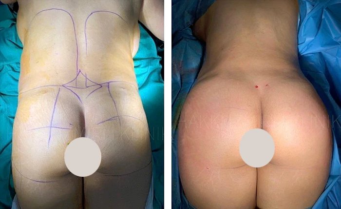 before & after photo of Brazilian Butt Lift