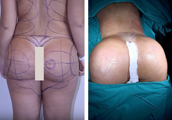 before & after photo of brazilian-butt-lift
