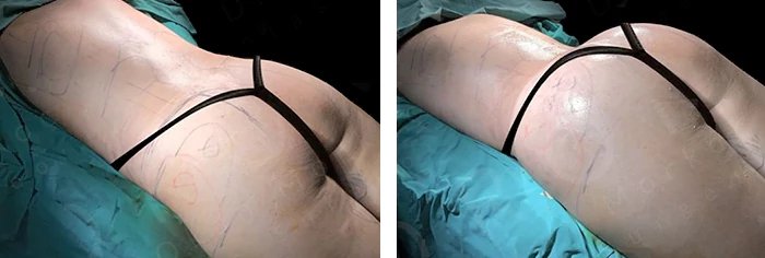 before & after photo of Tummy Tuck