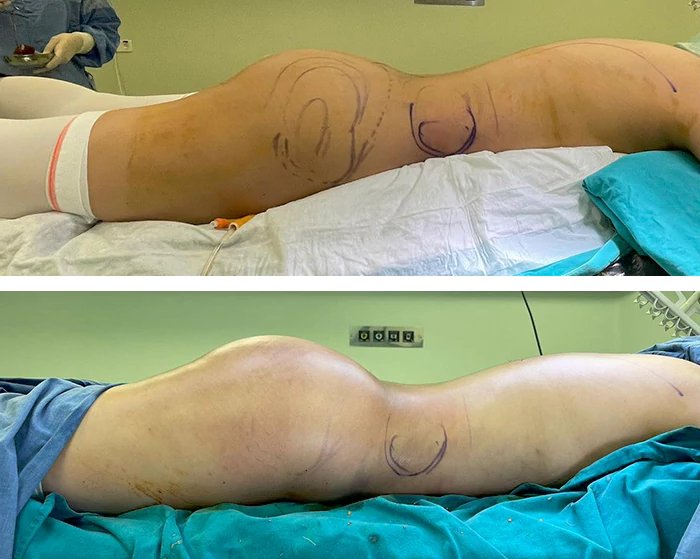 before & after photo of Brazilian Butt Lift