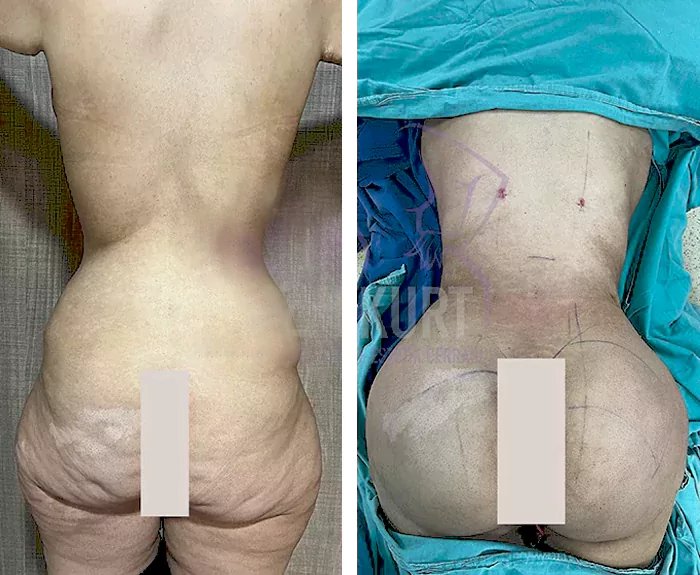 before & after photo of Brazilian Butt Lift