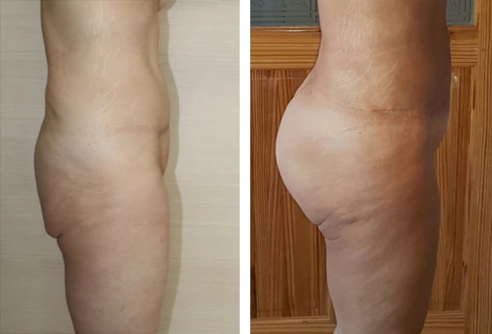 before & after photo of Brazilian Butt Lift