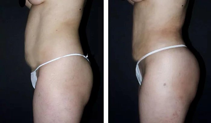 before & after photo of Tummy Tuck