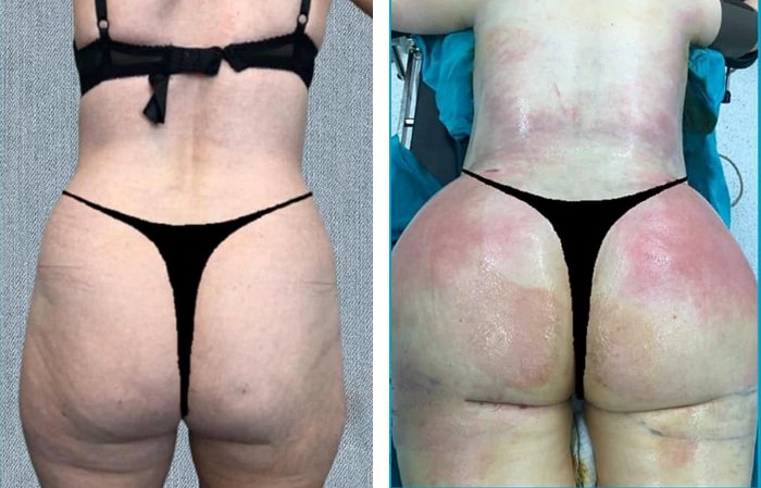 before & after photo of Tummy Tuck