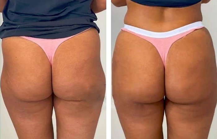 before & after photo of Tummy Tuck