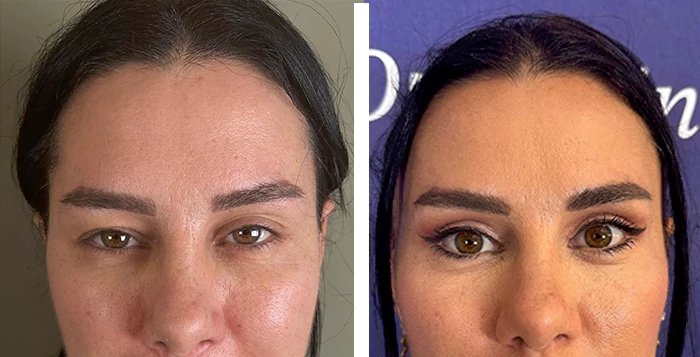 before & after photo of عملية تجميل الجفون