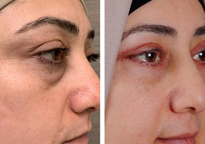 before & after photo of عملية تجميل الجفون