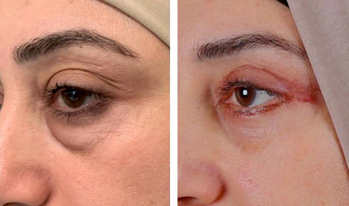 before & after photo of عملية تجميل الجفون