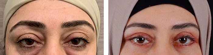 before & after photo of عملية تجميل الجفون