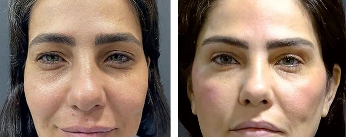 before & after photo of عملية تجميل الجفون