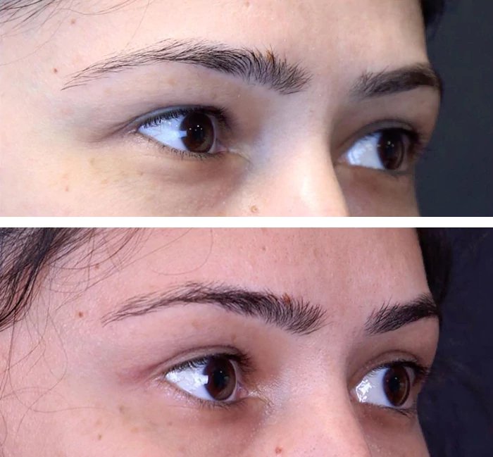 before & after photo of Double Eyelid Surgery