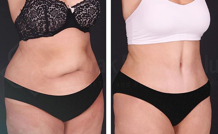 before & after photo of Body Lift