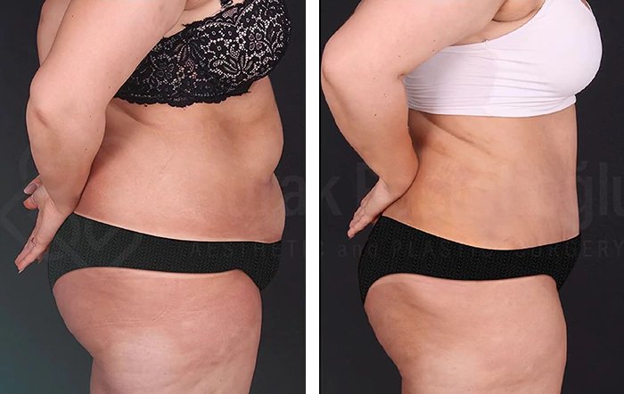 before & after photo of Body Lift