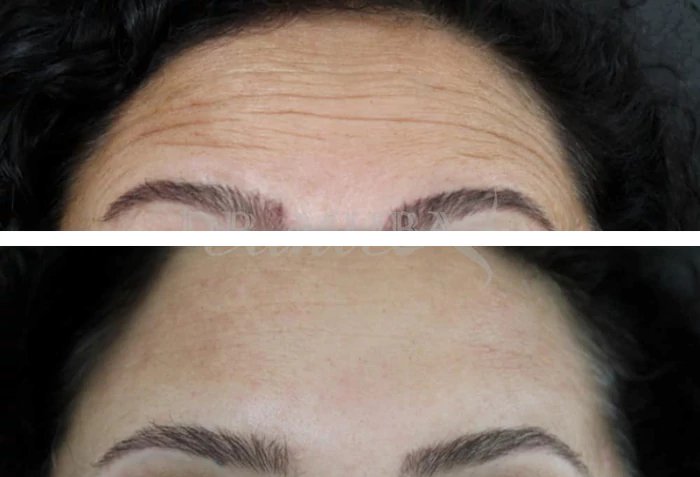 before & after photo of Botox & other Injectable Toxins