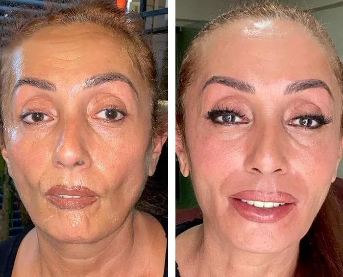 before & after photo of عملية تجميل الأنف