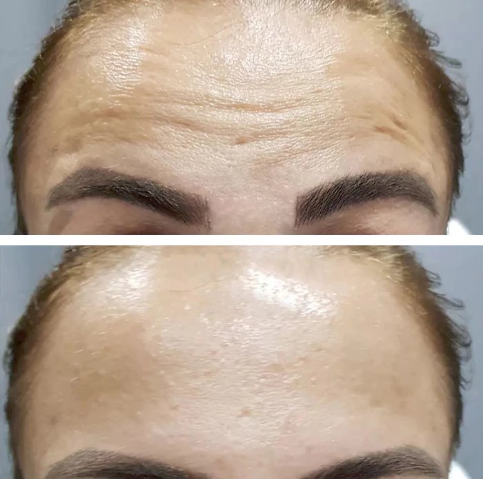 before & after photo of Nose Filler