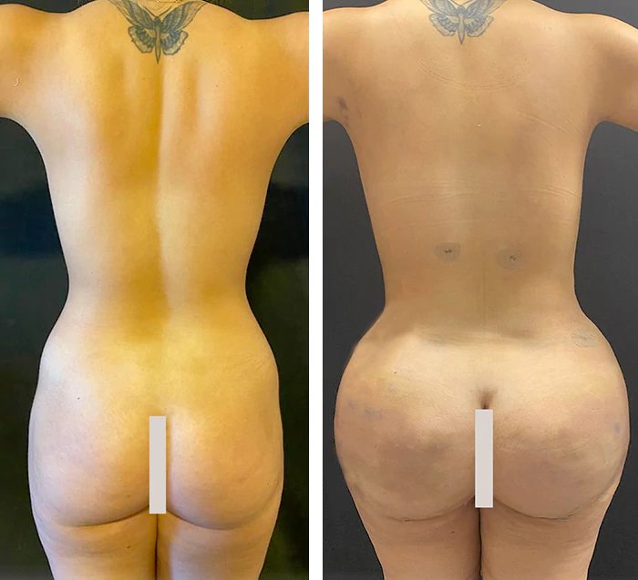 before & after photo of Tummy Tuck