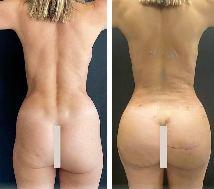 before & after photo of Tummy Tuck