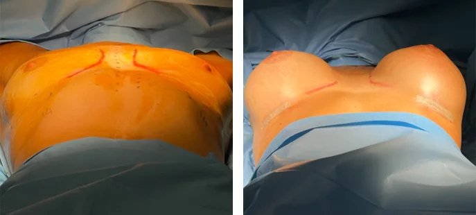 before & after photo of Tummy Tuck