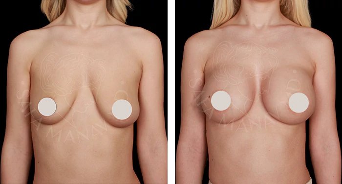 before & after photo of Tummy Tuck