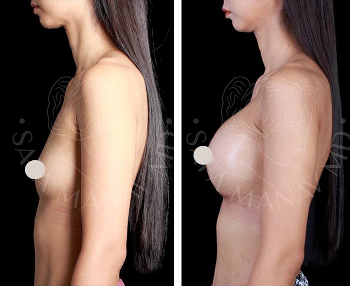 before & after photo of Tummy Tuck