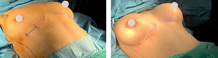 before & after photo of Tummy Tuck