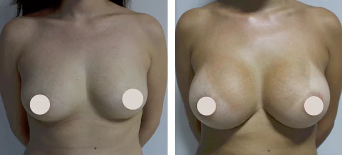 before & after photo of Liposuction